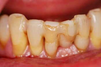 Dentures